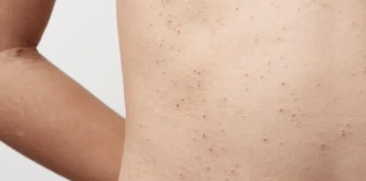 Argentina desarrolla el primer biosimilar para tratar la enfermedad de Fabry en la&nbsp;región